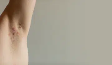 ¿Qué es la foliculitis?